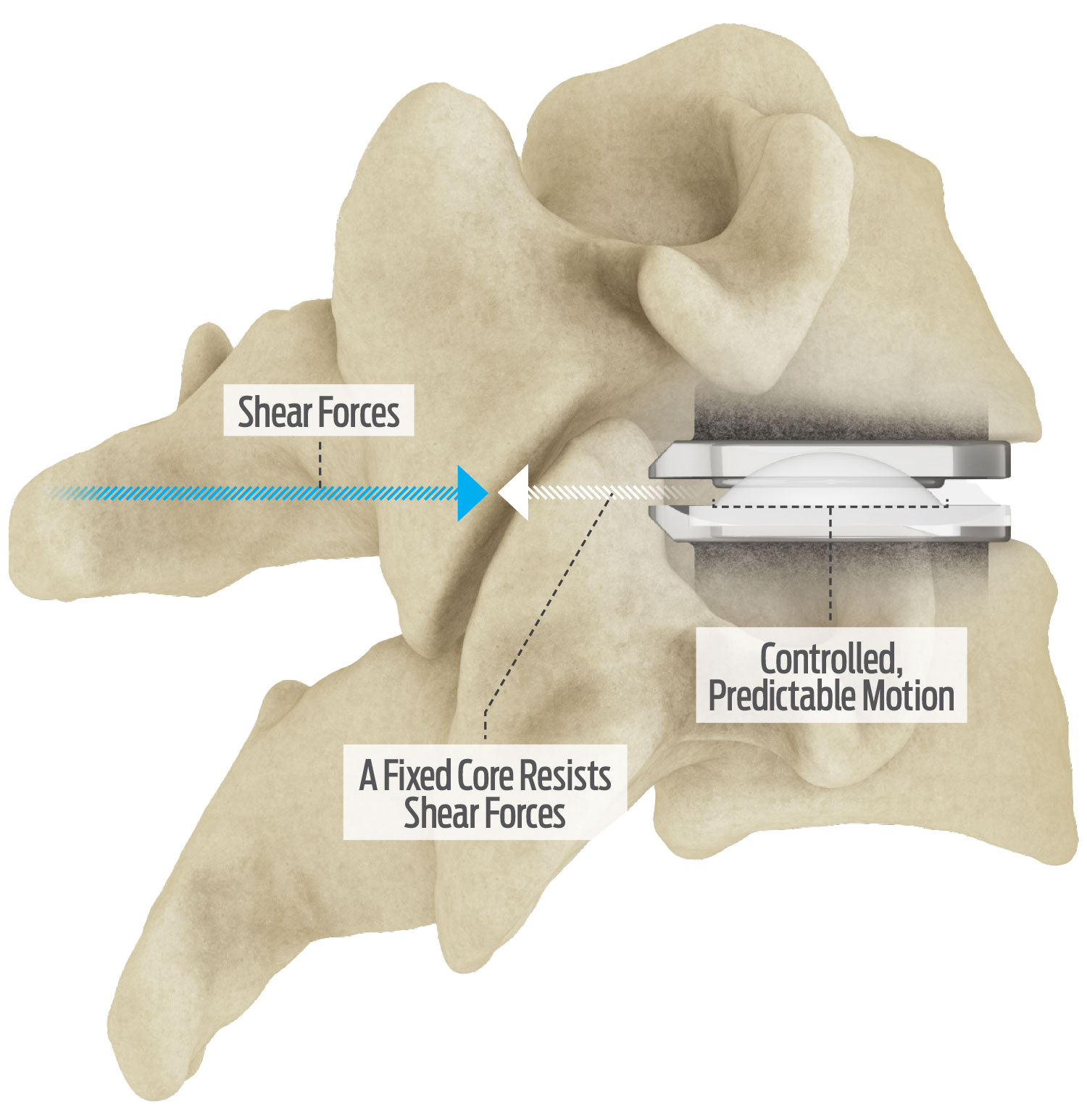 Centinel Spine